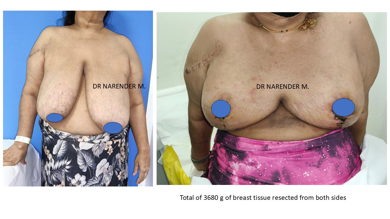 Breast Reconstruction Photo 6
